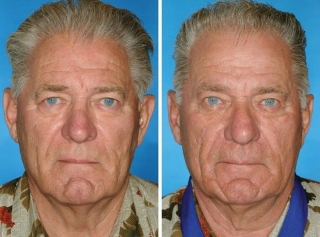 Φωτογραφίες δίδυμων που αποδεικνύουν ότι το κάπνισμα προκαλεί πρόωρη γήρανση