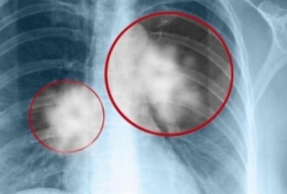 Απίστευτη είδηση! Βρέθηκε το εμβόλιο για τον καρκίνο του πνεύμονα και δίνεται δωρεάν!!!