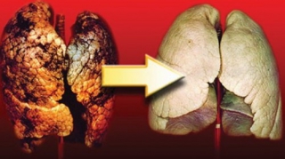 Αυτός είναι ο καλύτερος φυσικός τρόπος για να καθαρίσετε τους πνεύμονές σας απο Νικοτίνη και Πίσσα!